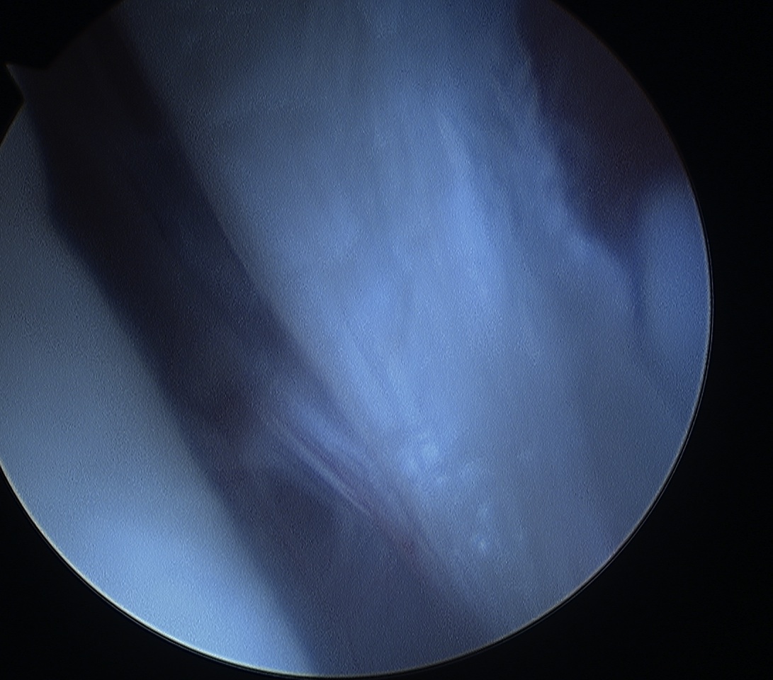 Anterior Bankart Lesion